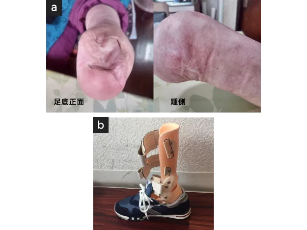 リスフラン（Lisfranc）切断