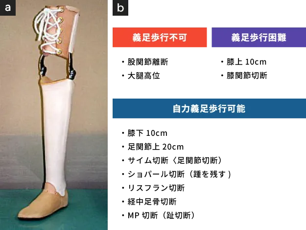 膝関節離断術（Through Knee Amputation）
