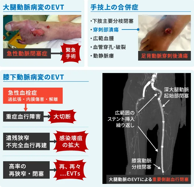 図1. カテーテル治療の様々な合併症