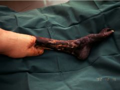 壊死肢：足壊疽が広範な例