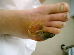 典型的な虚血性足趾壊疽