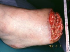 図51－aの潰瘍に対する足尖部切断