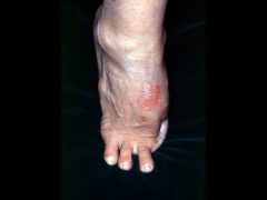 足趾壊疽による変形治癒：第1、4趾欠損。足救済では生きている趾はすべて残す