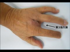 透析患者さんの指壊疽に対し定型切断が行われたために第３指が欠損となった。図1の様に指血行障害に対しては決して定型切断を行ってはならない