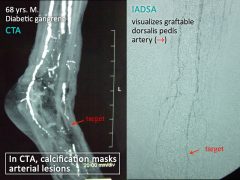 病変の診断には血管造影が必要：造影剤を直接動脈に注入する方法(IADSA)が必須 〔左：CT血管造影法、石灰化により病変が診断できない；右： IADSA,石灰化が除かれ病変が描出される）