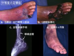 血行障害と感染の合わさった足壊疽：治療前と血管移植手術後の比較