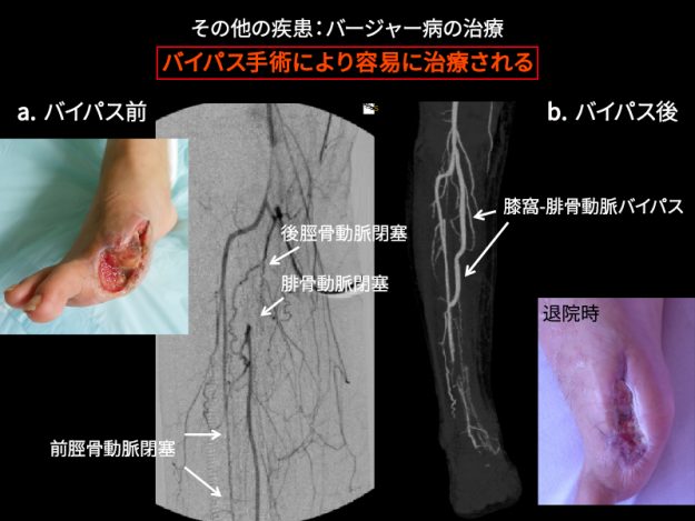 足趾壊疽の治療の実際 血管外科医 笹嶋唯博