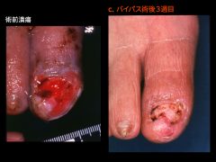バージャー病の難治性趾潰瘍のバイパス後治癒