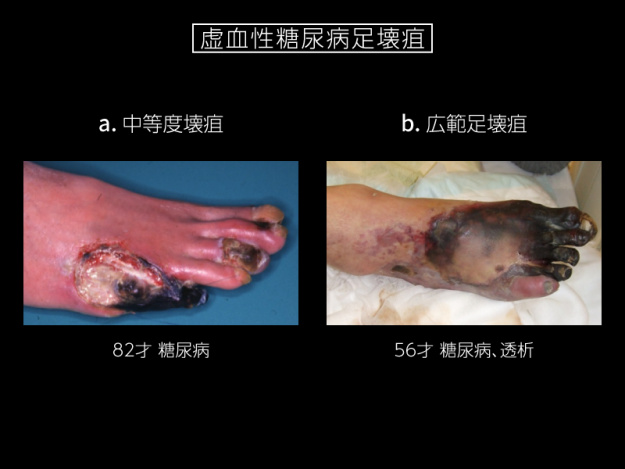 足趾壊疽の治療の実際 血管外科医 笹嶋唯博